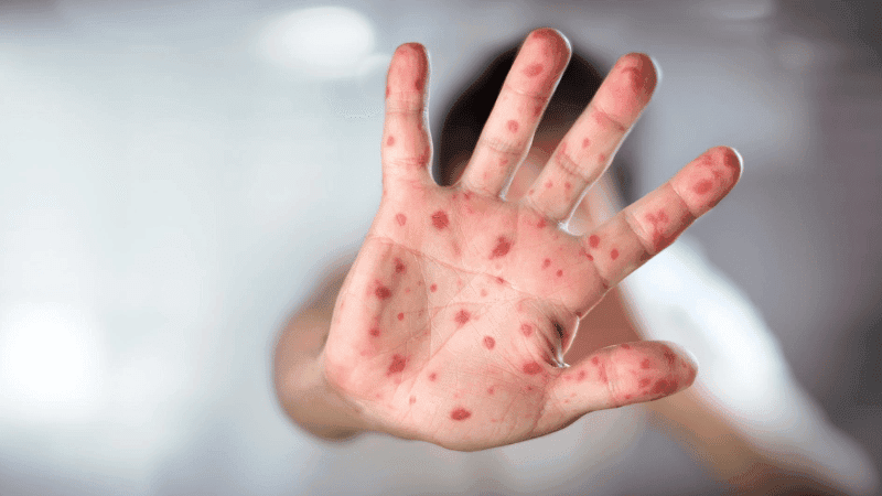 Nine more children die with measles symptoms, 1,105 new cases detected