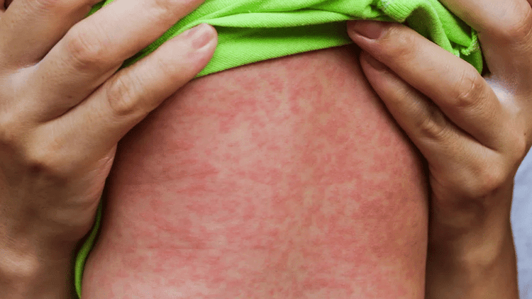 5 more children die from Measles, Measles-like symptoms in 24 hrs