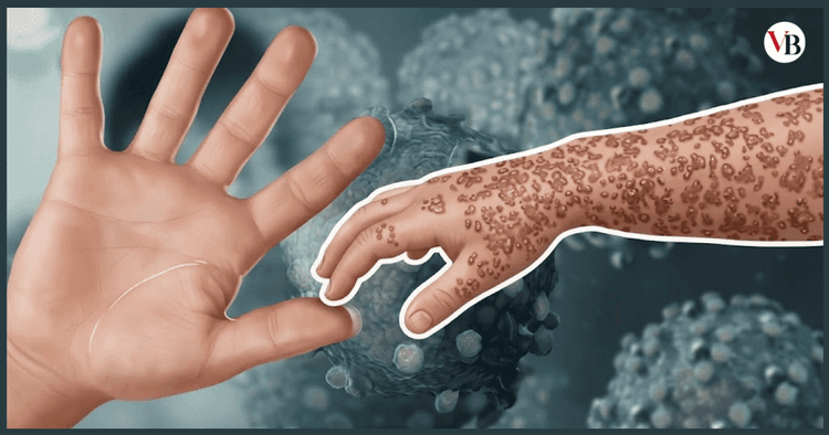 Four children die with measles symptoms in Sylhet in 24 hours