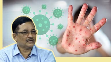 Along with measles, children are being infected with adenovirus: Dr. Muaz