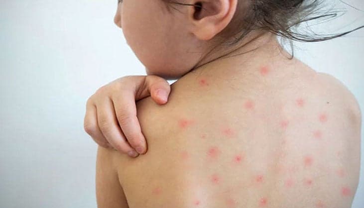 38 children die from measles outbreak across country
