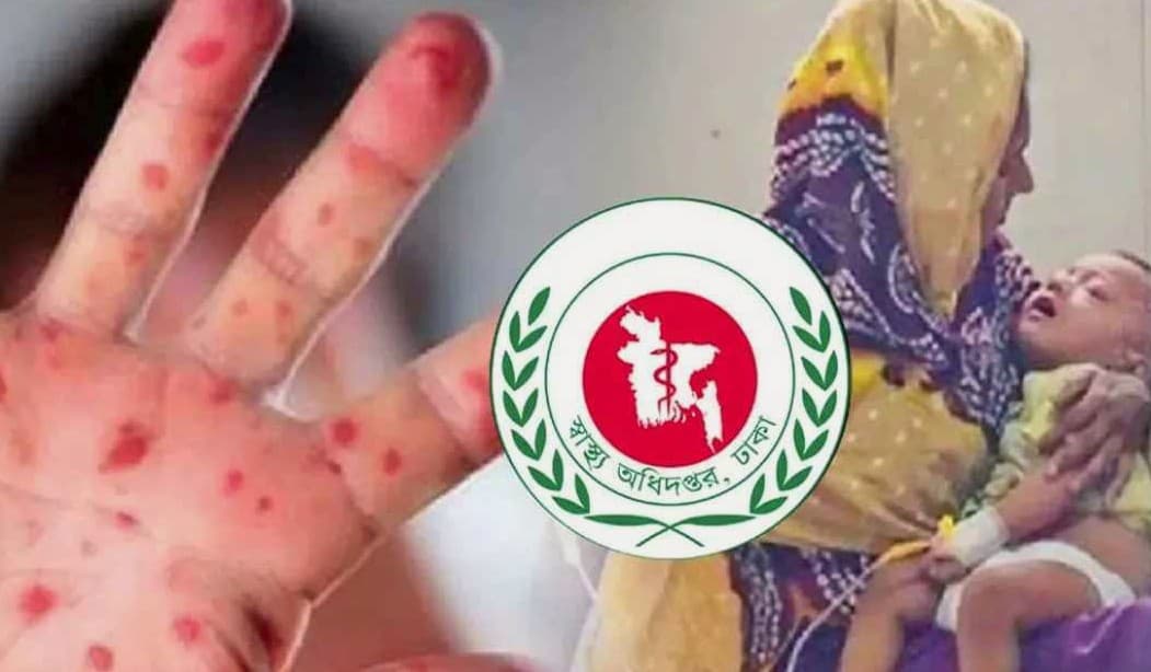 Three die with measles symptoms in 24 hours, death toll reaches 498