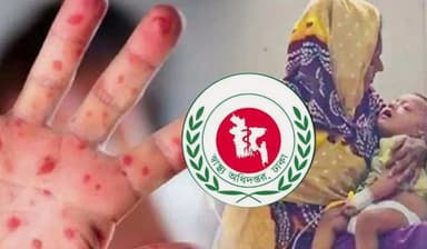 Three die with measles symptoms in 24 hours, death toll reaches 498