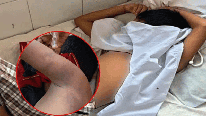 7-year-old admitted to hospital after madrasa teacher's beating in Bagerhat