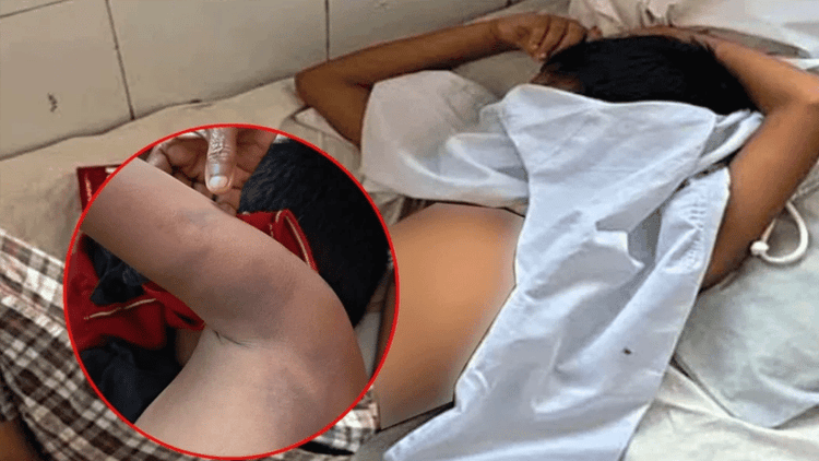 7-year-old admitted to hospital after madrasa teacher's beating in Bagerhat