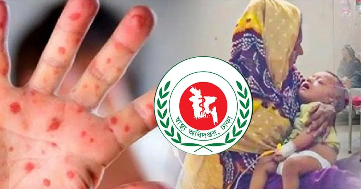 Measles outbreak: Three more children die in 24 hours
