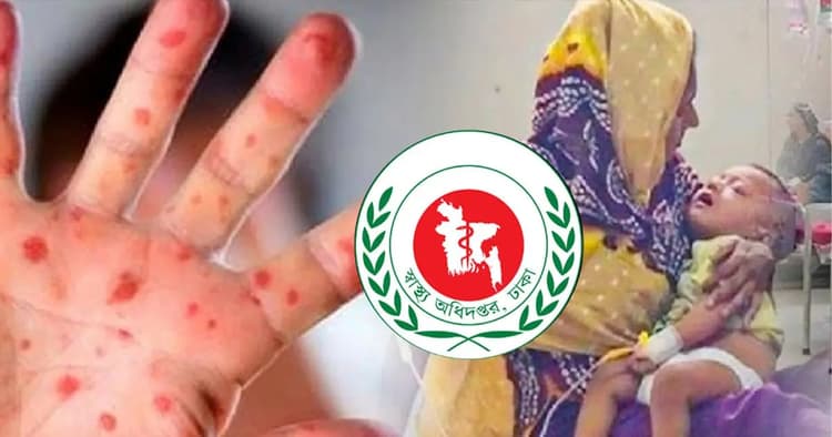 Measles claims lives of 3 more children in 24 hours