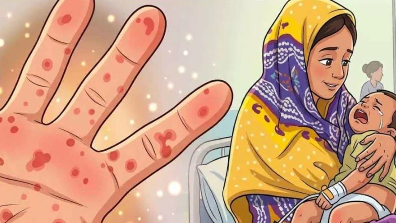 7 more children die of measles symptoms, total deaths 677