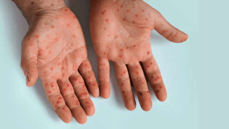 Nurse dies with measles symptoms in Sylhet