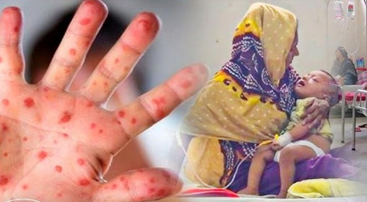 Measles claims 6 more children, death toll rises to 908