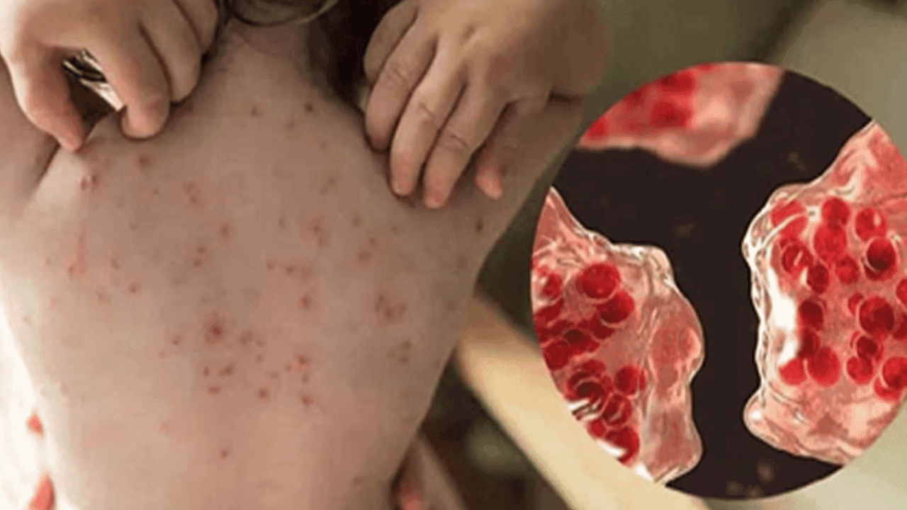10 more children die of measles symptoms, total deaths 575