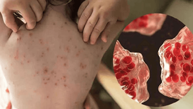 10 more children die of measles symptoms, total deaths 575