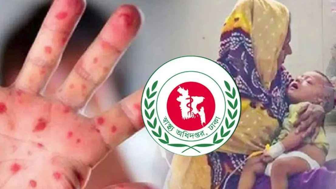 16 more children die from measles in 24 hours