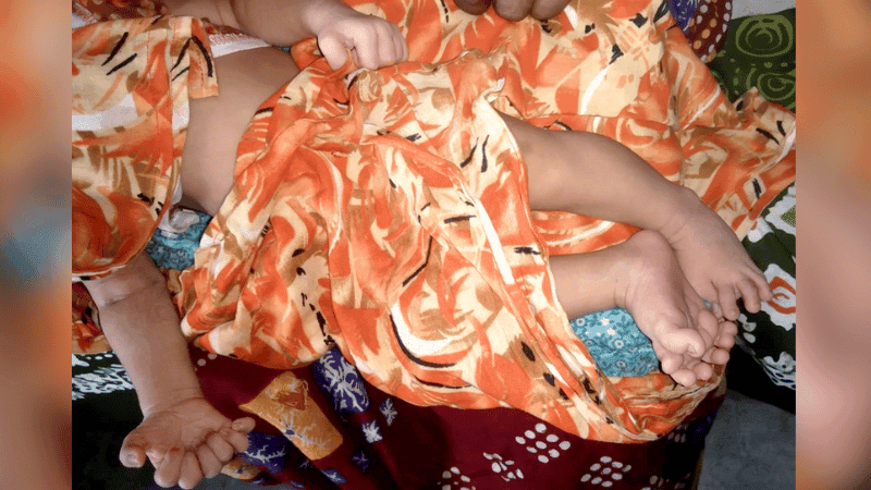 Girl born with 28 fingers and toes
