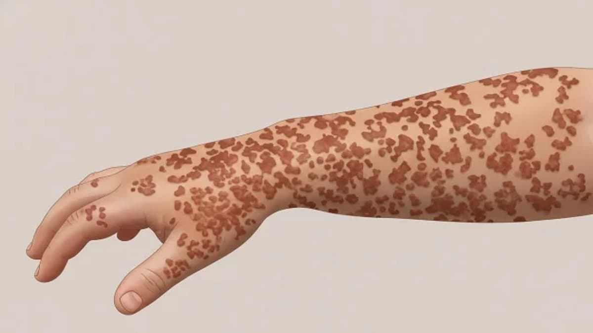 Two more die from measles in 24 hours, 1377 new cases