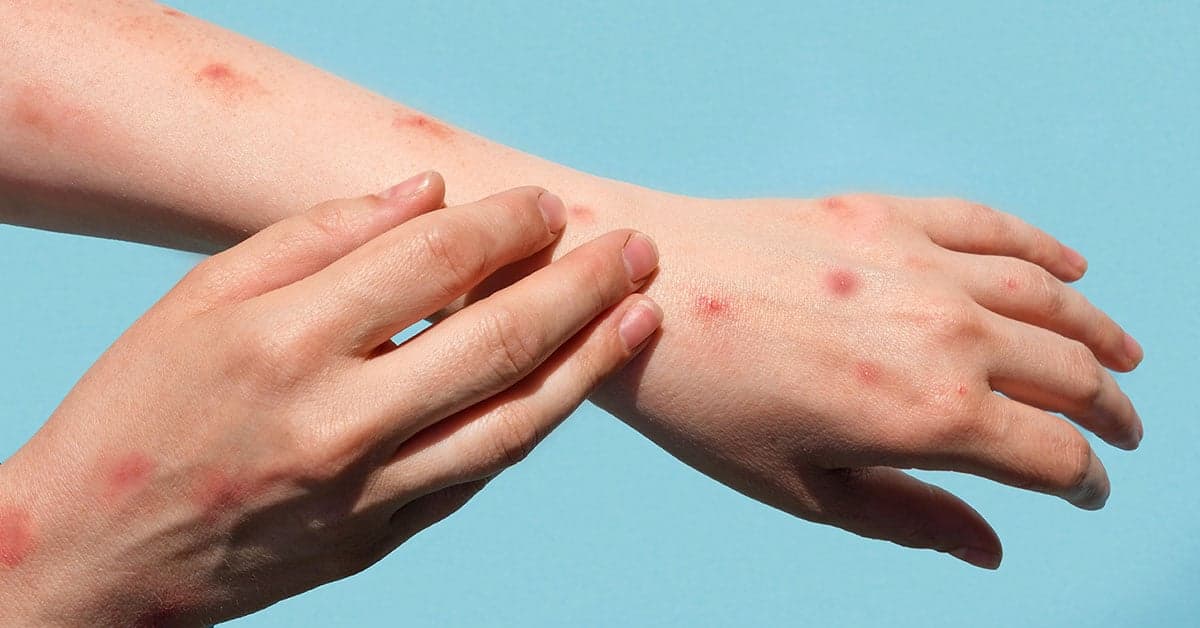 Mpox is not the new COVID: WHO