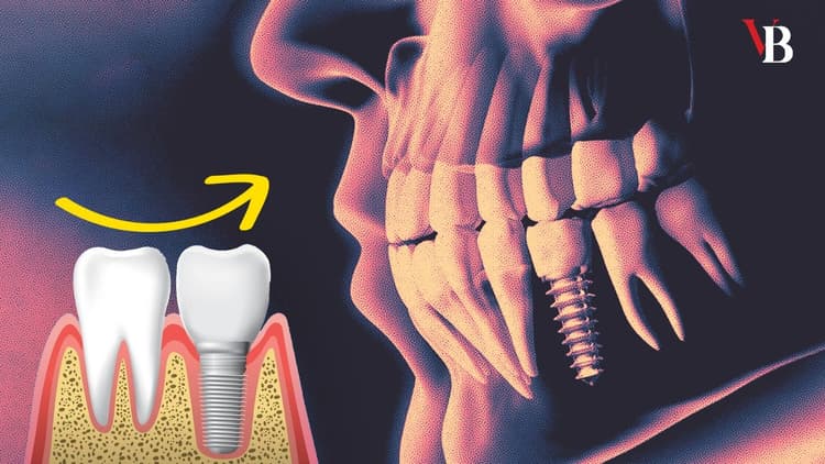 dental implant