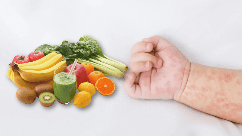 Feeding children with Measles: What to give and what to avoid