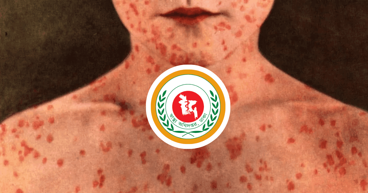 Four more deaths with measles symptoms, 1,349 new patients