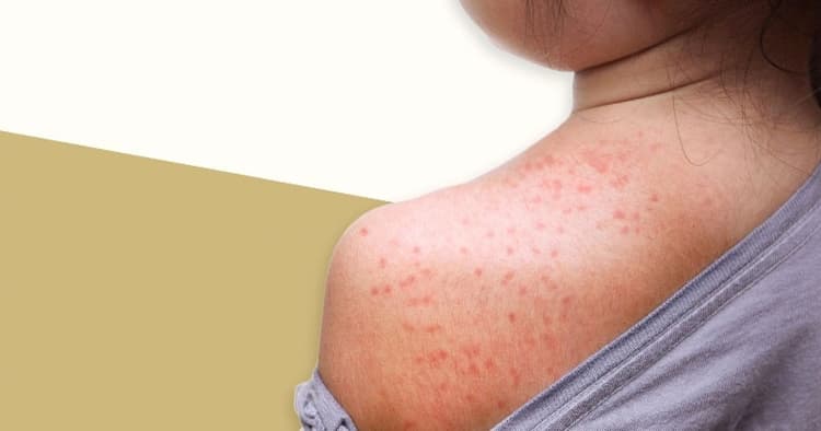 10 children die with measles symptoms in 24 hours